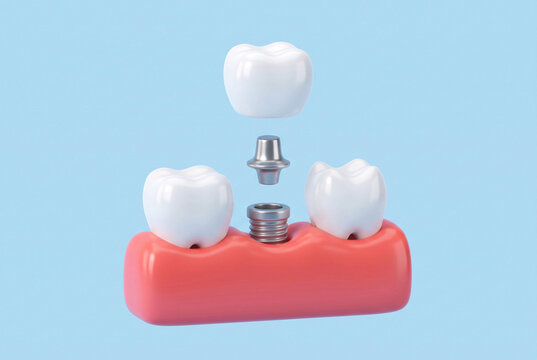 Dental implant procedure concept, 3D render showing crown, abutment and implant screw being placed into gum between healthy teeth, missing tooth replacement