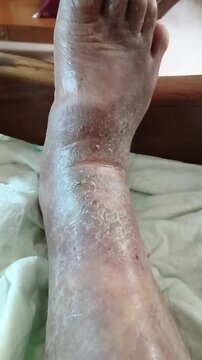 Darkened and Thickened Skin on Foot Due to Eczema