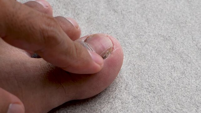 Index finger scratching painful ingrown toenail on big toe