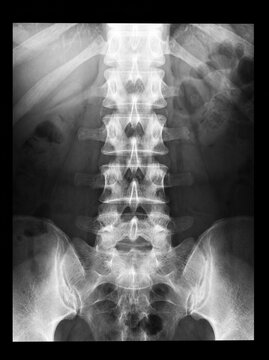 AP lumbar spine X-ray showing lower back bone alignment