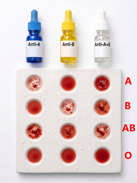 ABO Blood Typing Test and Agglutination Reaction.