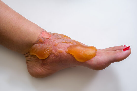 Foot with second degree burns and blisters