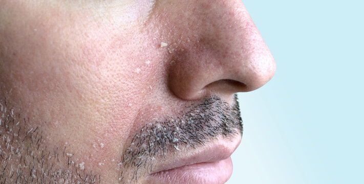 Dermatitis seborreica facial con descamaci&oacute;n y piel grasa