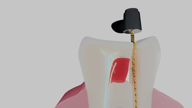 Molar cross section showing endodontic treatment on dark floor