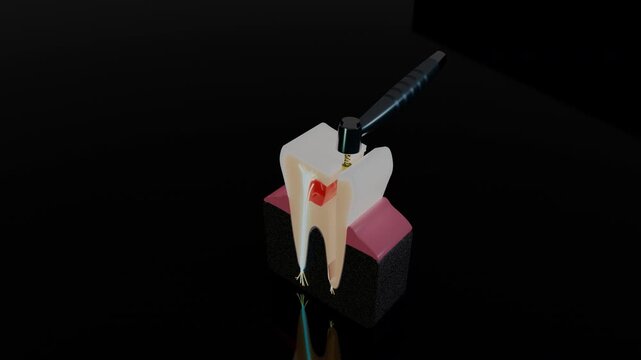 Endodontic file treating root canal in molar tooth cross section