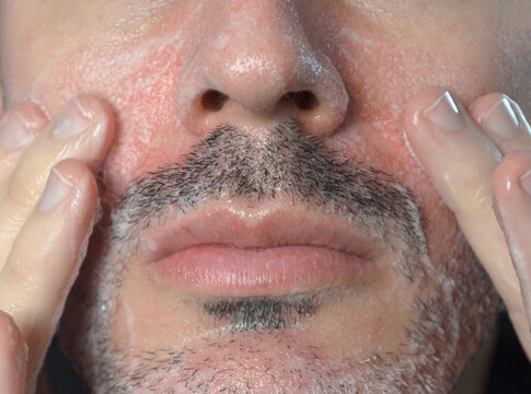 Tratamiento antimic&oacute;tico y regulador de sebo para control de dermatitis facial 