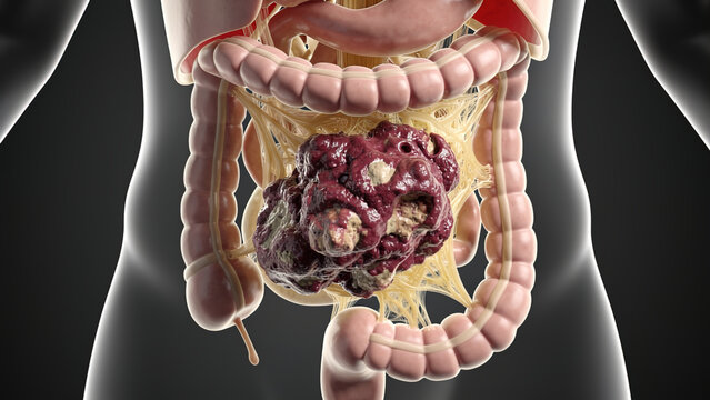 3D medical visualization of large malignant mesenteric sarcoma tumor in human abdominal cavity, intestines and mesentery, dark background