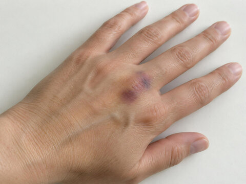 Swollen Purple Impact Bruise on Back of Hand
