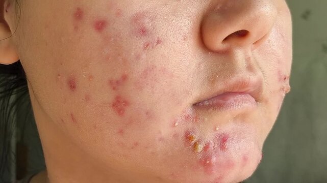 a young woman with acne, inflamed pimples and a pus-filled blemish on the face, illustrating problematic skin and adolescent acne.