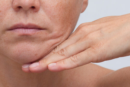 Woman s face showing jowls and nasolabial folds with a hand supporting the cheek