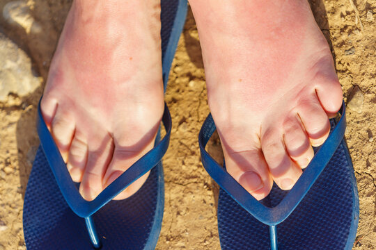 Sunburned feet wearing blue flip-flops on a sandy surface during a sunny day at the beach in summer