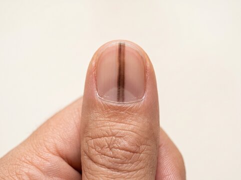 Dark longitudinal streak on fingernail with clean copy space