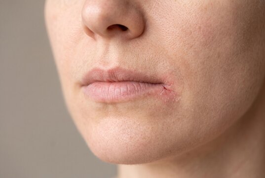 Close-up of a person lower face showing a cracked mouth corner and skin irritation from angular cheilitis