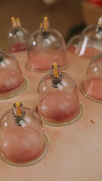 close-up cupping cups on skin create raised reddish circles inside clear domes with warm light and spa focus