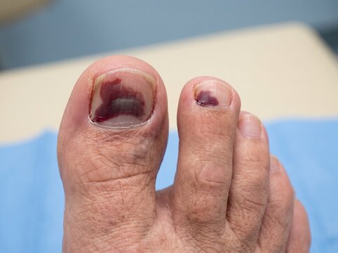 Multiple toenail subungual hematomas following foot trauma