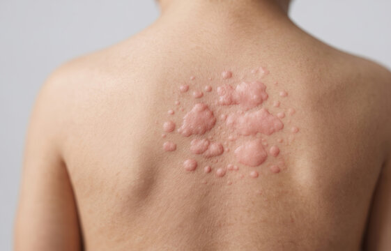 Close Up of Severe Hives Urticaria and Allergic Reaction Rash on Child Back