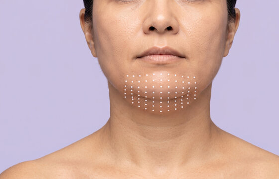Close-up of a woman's lower face with white dots on her double chin, indicating targeted injection sites for fat dissolving treatments.