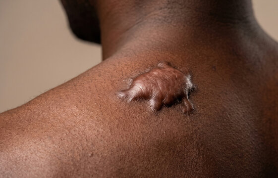 Large raised keloid scar and hypertrophic fibrotic tumor tissue on the shoulder back of African American man