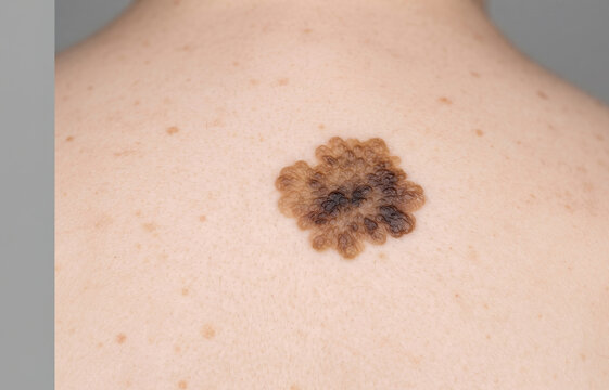 Close up of a benign seborrheic keratosis senile wart lesion on the back skin of a caucasian patient
