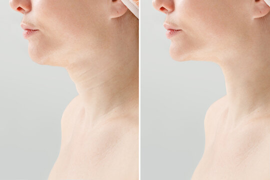 Before and After Facial Rejuvenation with Improved Chin and Jawline Contour