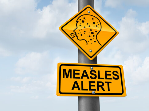 Measles Outbreak Health Crisis as a highly contagious viral disease that causes fever rash and respiratory complications and routine childhood