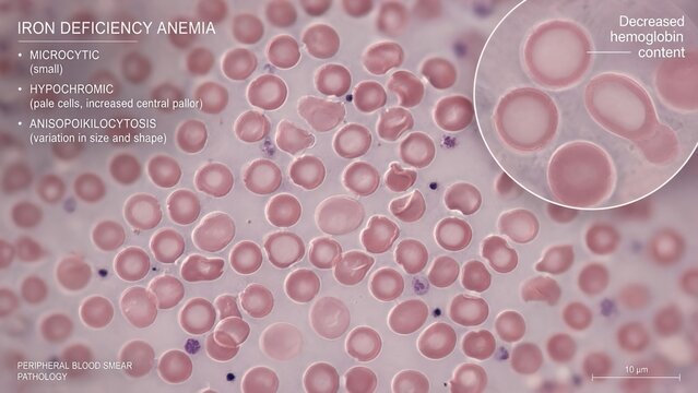 Microcytic hypochromic anemia blood smear showing small pale red blood cells with increased central pallor and anisopoikilocytosis in microscopic pathology view