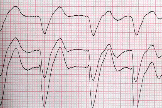 Electrocardiogram trace showing abnormal cardiac rhythm lead signal on paper