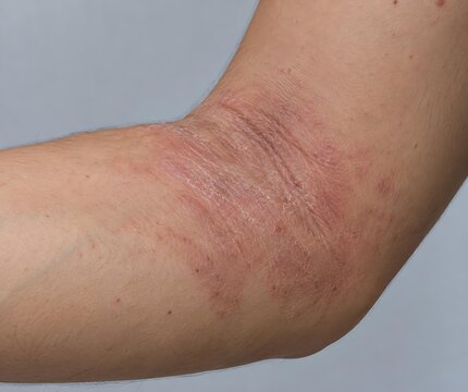 Realistic Flexural Eczema on Adult Inner Elbow With Dry Scaly Inflamed Skin, Dermatology Close-Up