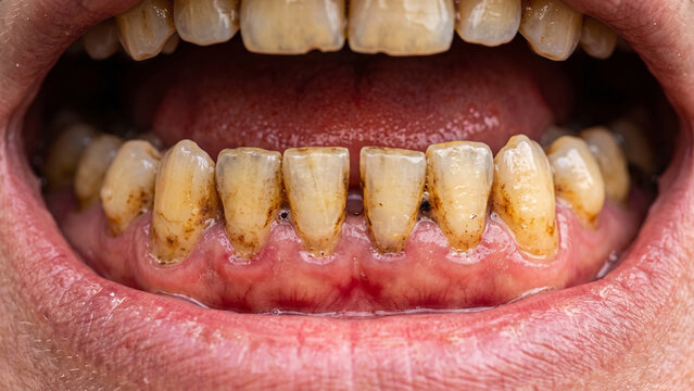 Teeth showing heavy plaque buildup and gingival inflammation require immediate dental intervention to restore oral health and prevent the progression of periodontal disease in this clinical closeup.