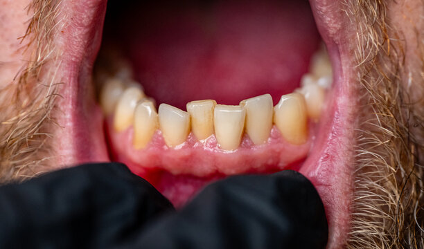 dental examination of lower teeth row close up, dentist inspecting human lower jaw and gums in medical gloves, macro view of human teeth and gums during stomatology checkup