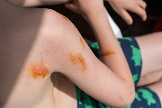 Multiple fresh abrasions on child's knee and arm after fall