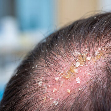 macro human scalp with seborrheic dermatitis inflammation and dandruff flaking photorealistic medical skin detail daylight bokeh background