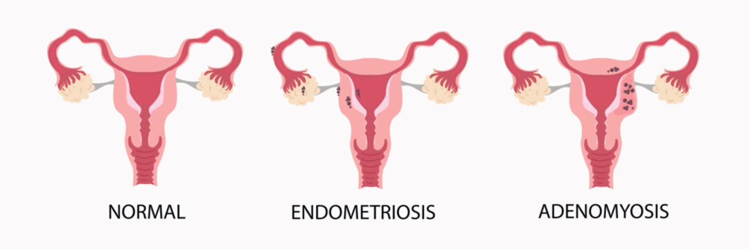 Uterus Anatomy with Endometriosis and Adenomyosis. medical illustration. 