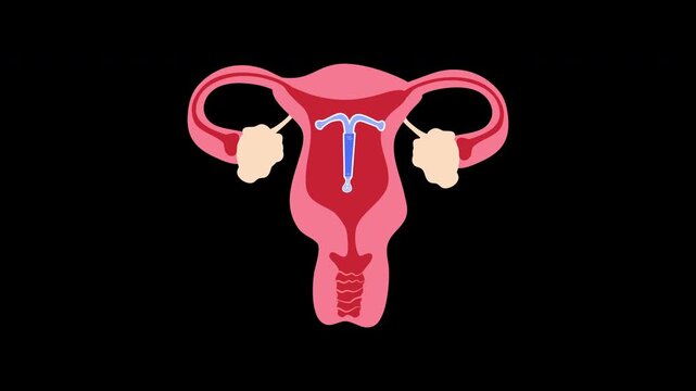 Illustration of Intrauterine Device in Uterus