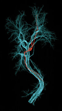 Machine learning aids in aneurysm detection in brain MRA scans