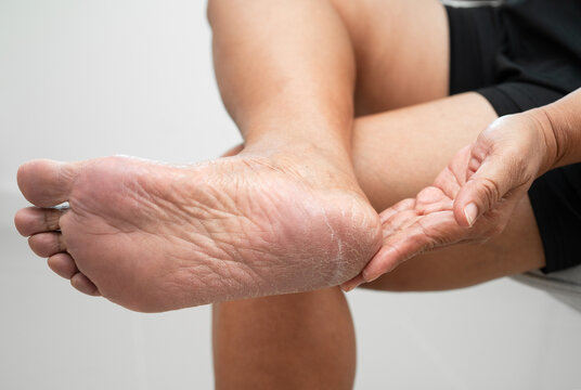 Asian woman check feet with crack and dry heel skin, Diabetic Foot.