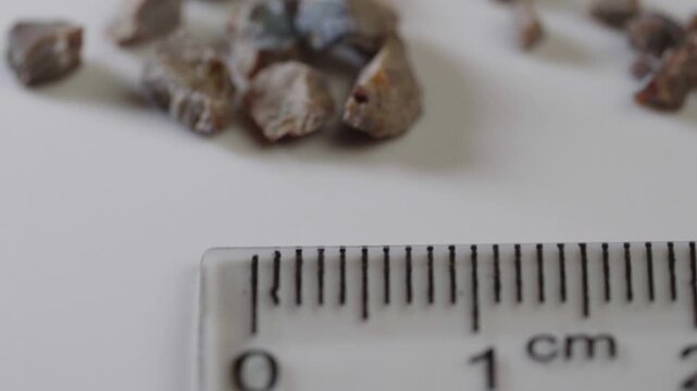 Fragments of a kidney stone crushed by ultrasound with a diameter of 1.5 centimeters