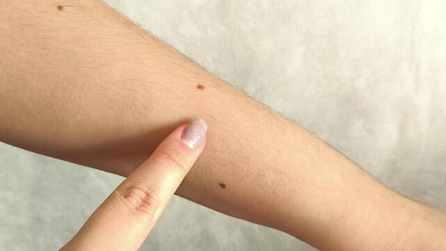 a woman checking pigmented moles on her hand, representing regular skin monitoring, dermatological awareness and preventive healthcare.