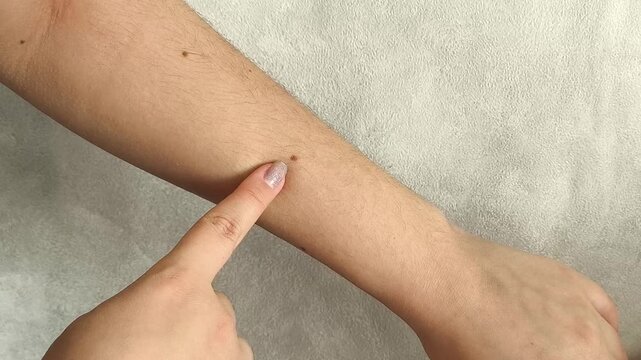 Woman examining moles on her hand and arm, illustrating skin self-examination, preventive dermatology and monitoring of skin changes.
