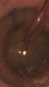 Professional ophthalmologist performing cataract removal and intraocular lens (IOL) implantation under a surgical microscope in an operating room.