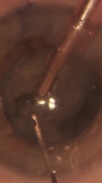 Professional ophthalmologist performing cataract removal and intraocular lens (IOL) implantation under a surgical microscope in an operating room.
