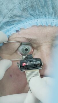 Professional ophthalmologist performing cataract removal and intraocular lens (IOL) implantation under a surgical microscope in an operating room.