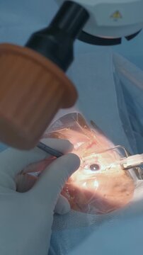 Professional ophthalmologist performing cataract removal and intraocular lens (IOL) implantation under a surgical microscope in an operating room.