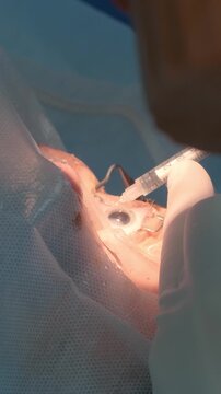 Professional ophthalmologist performing cataract removal and intraocular lens (IOL) implantation under a surgical microscope in an operating room.