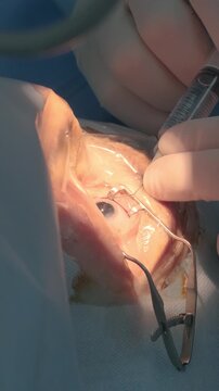 Professional ophthalmologist performing cataract removal and intraocular lens (IOL) implantation under a surgical microscope in an operating room.