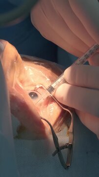 Professional ophthalmologist performing cataract removal and intraocular lens (IOL) implantation under a surgical microscope in an operating room.