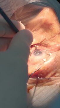 Professional ophthalmologist performing cataract removal and intraocular lens (IOL) implantation under a surgical microscope in an operating room.