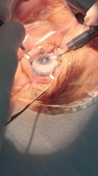 Professional ophthalmologist performing cataract removal and intraocular lens (IOL) implantation under a surgical microscope in an operating room.
