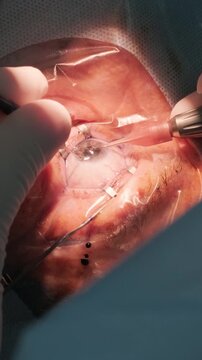Professional ophthalmologist performing cataract removal and intraocular lens (IOL) implantation under a surgical microscope in an operating room.