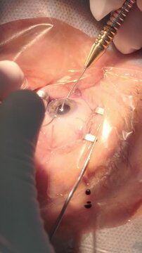 Professional ophthalmologist performing cataract removal and intraocular lens (IOL) implantation under a surgical microscope in an operating room.